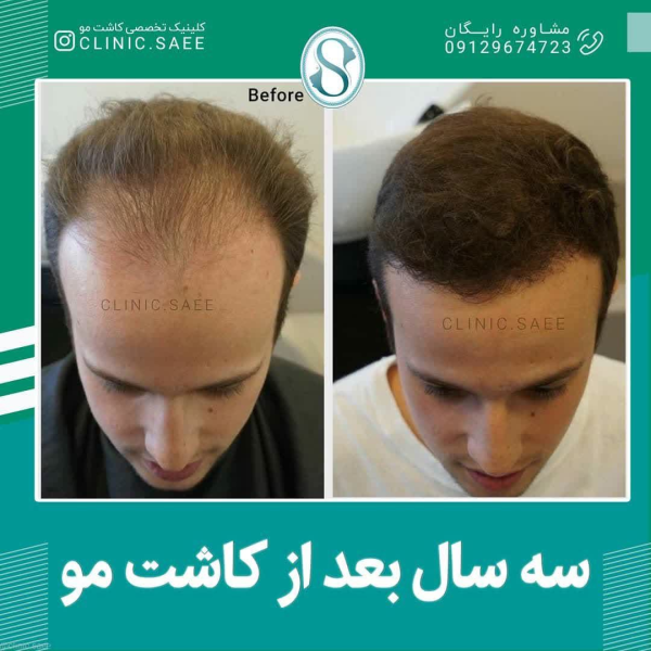 برترین روش کاشت مو در ایران