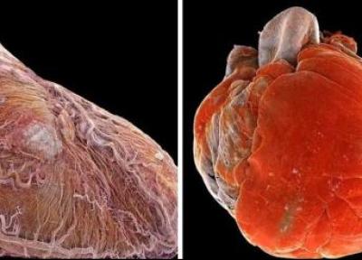 تفاوت آشکار بین قلب سالم و بیمار در یک عکس